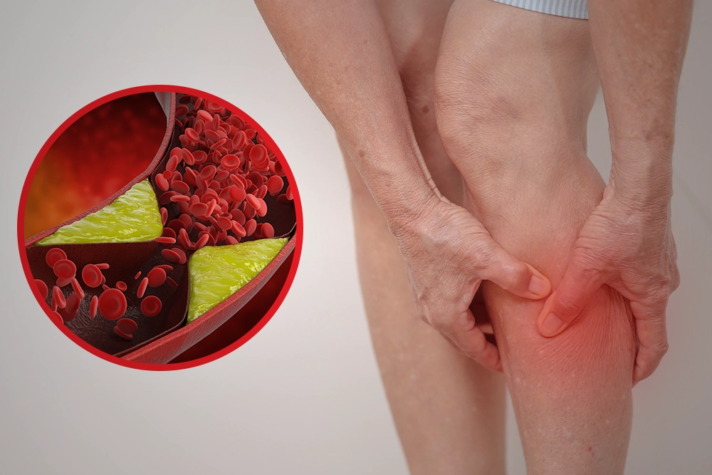 Kako prirodnim putem zaštititi vene